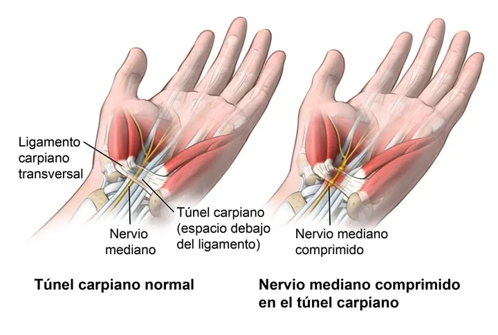 que es el sindrome del tunel carpiano anatomia.