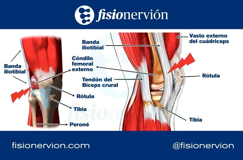 Anatomia musculoesquelética de la rodilla donde se observa la banda iliotibial o cintilla iliotibial para explicar el síndrome del corredor