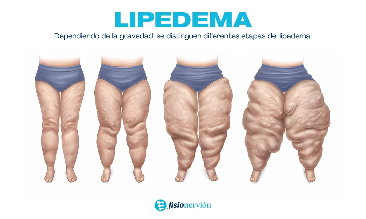 Etapas o grados del lipedema