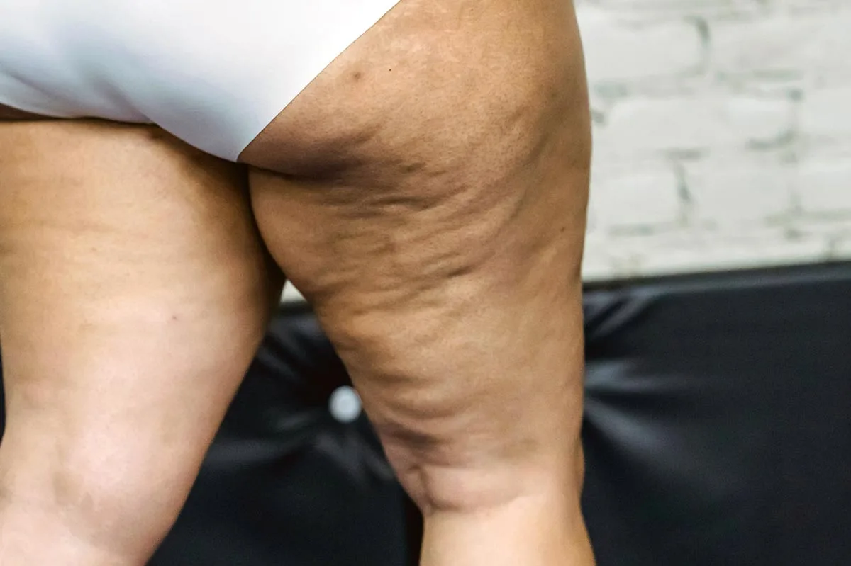 Lipedema