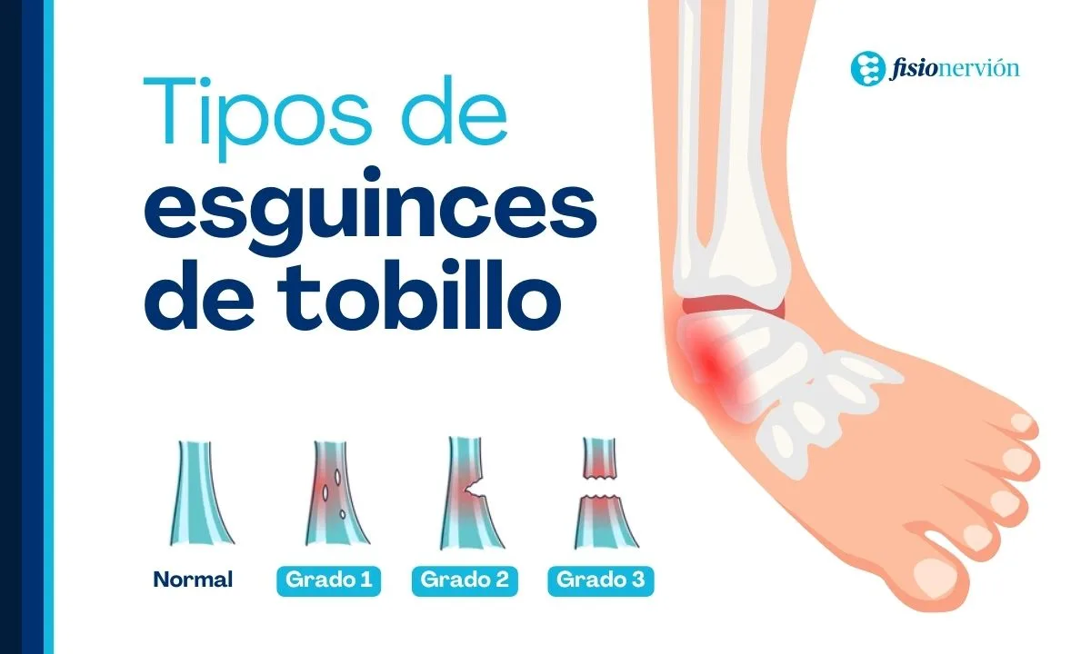 Tipos o Grados de Esguinces de Tobillo y Tiempos de Recuperación
