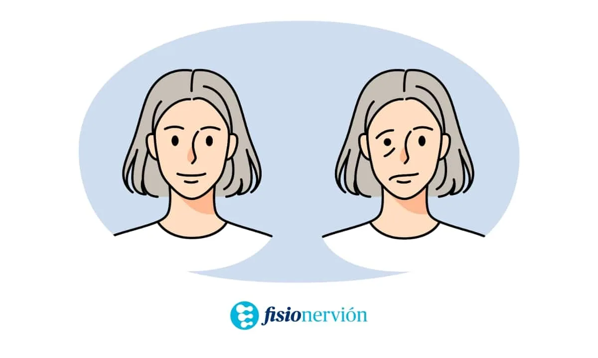 Paralisis-Facial-Fisioterapia